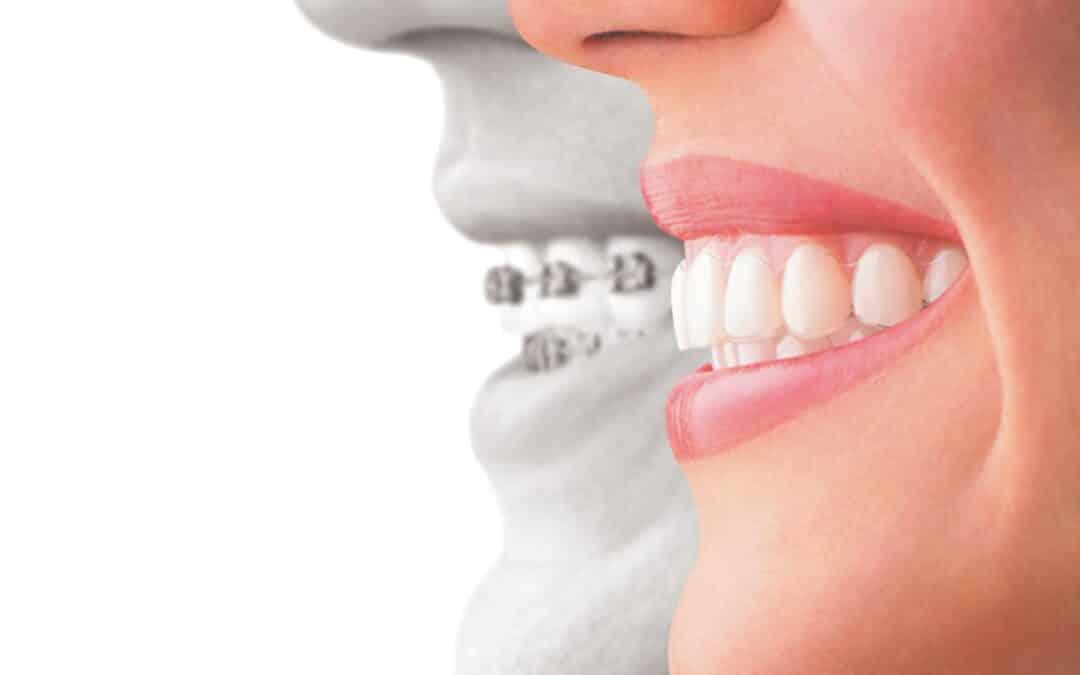 Ask Your Cuero Dentist: What’s the difference between Invisalign and Metal Braces?