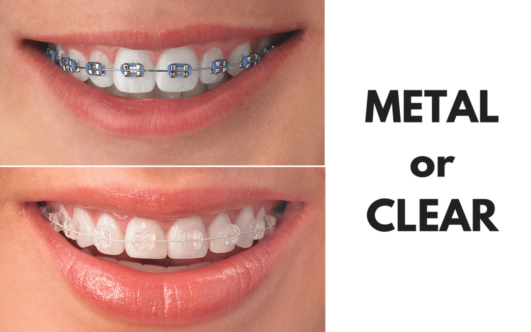 Ask Your Cuero Dentist: Should I Get Metal or Clear Braces?