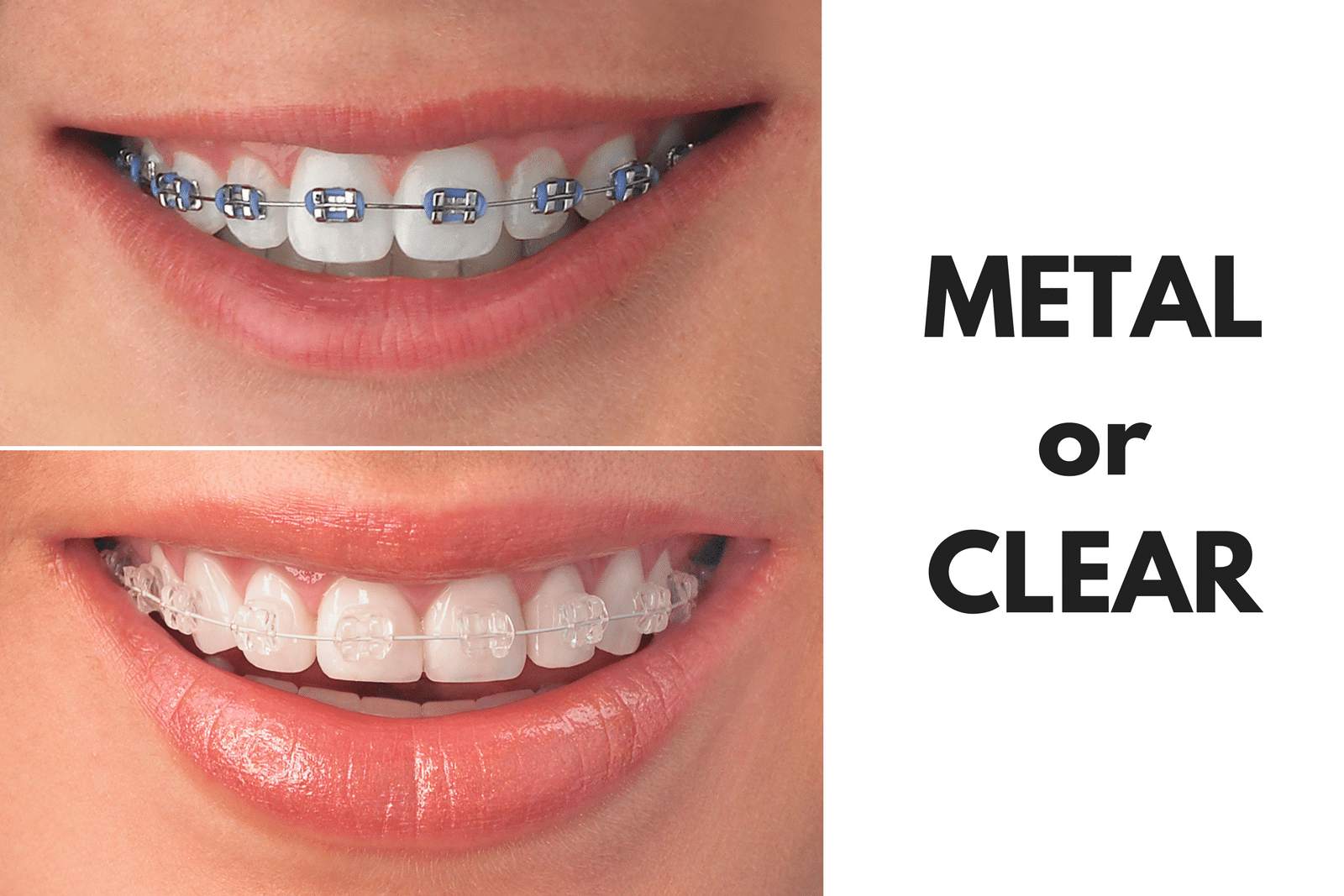 Ask Your Cuero Dentist: Should I Get Metal or Clear Braces?