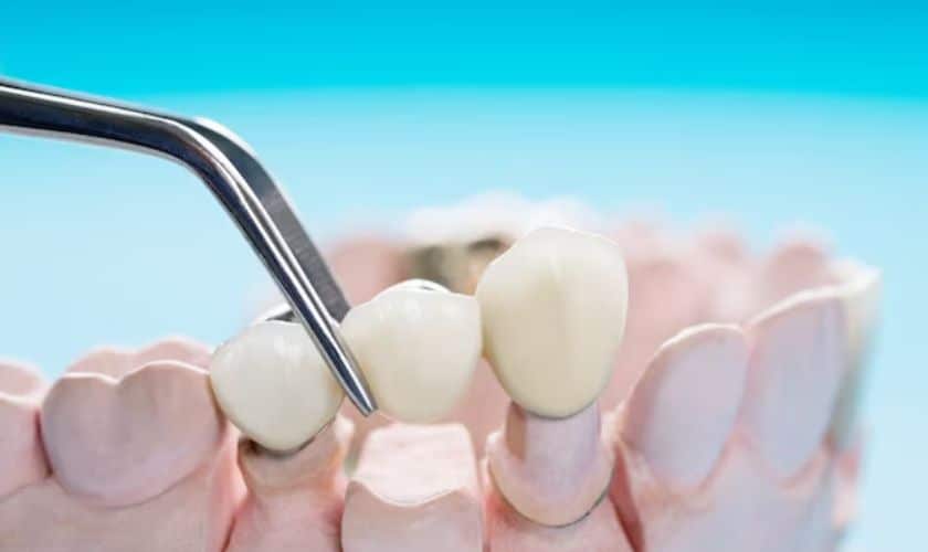 4 Ways In Which Dental Bridges Might Enhance Your General Health