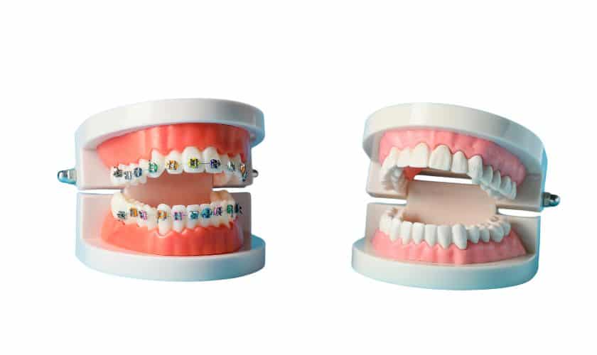 Orthodontic appliances for Teeth alignment